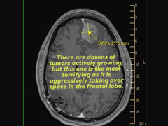 Een scan van Michael Prinke's MRI zoals geüpload door zijn vrouw op sociale media