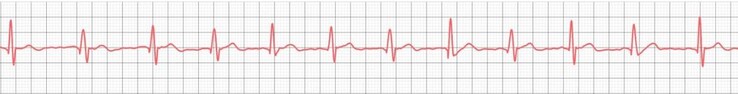 Zelfs goedkope smartwatches hebben aangetoond dat ze met succes eenvoudige ECG’s kunnen registreren