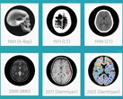 Darmiyan BrainSee medische AI-software kan vroegtijdig tekenen van Alzheimer opsporen. (Bron: Darmiyan)