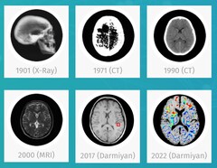 Darmiyan BrainSee medische AI-software kan vroegtijdig tekenen van Alzheimer opsporen. (Bron: Darmiyan)